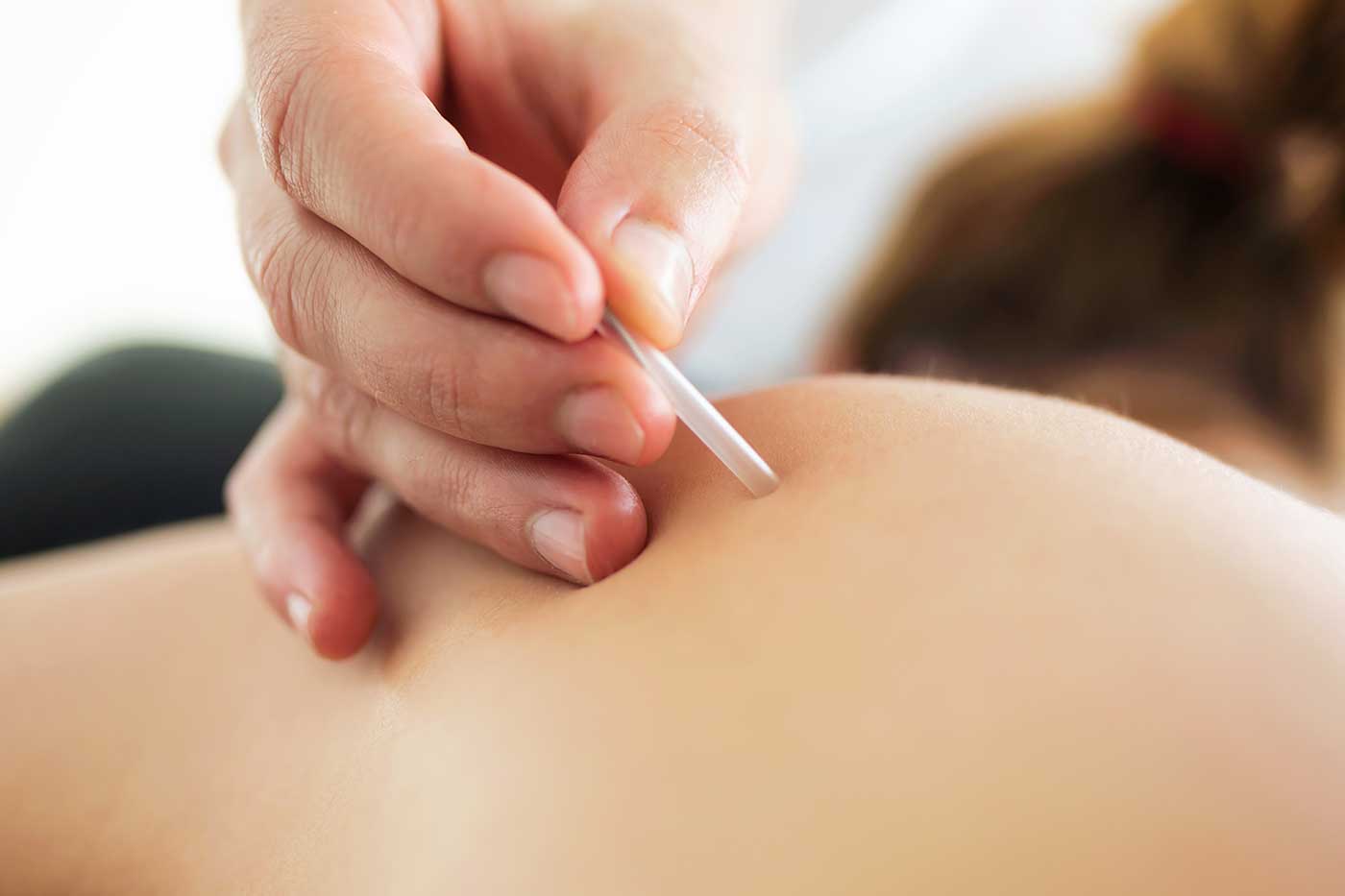 Waarom-Dry-Needling-Fysiotherapie